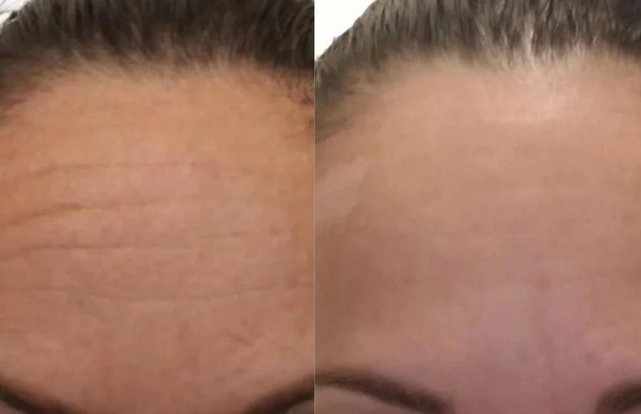 Lissage du front